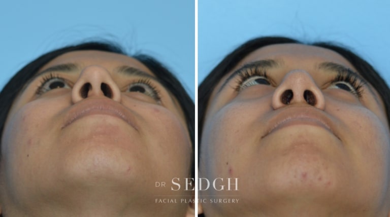 Female Rhinoplasty Before and After | Sedgh