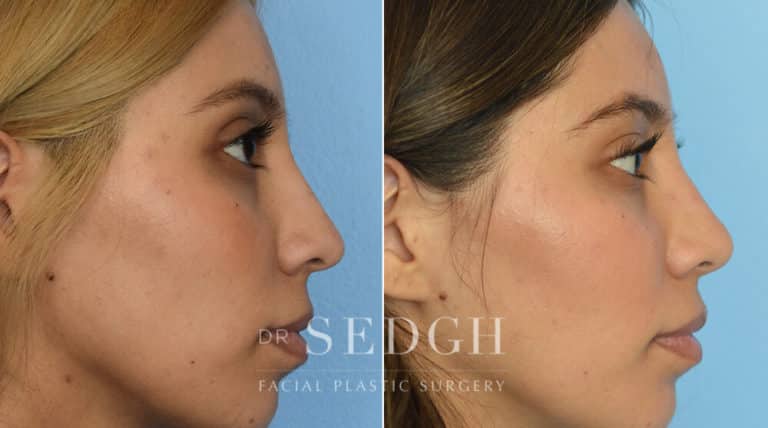 Rhinoplasty Before and After | Sedgh