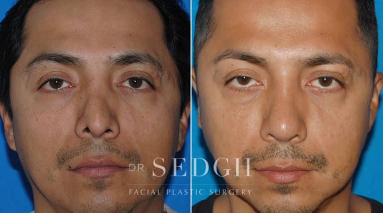 Latino Rhinoplasty Before and After | Sedgh