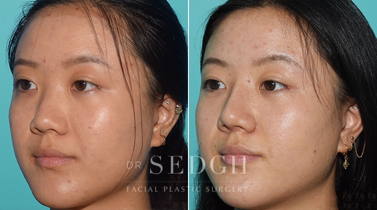 Asian Rhinoplasty Before and After | Sedgh