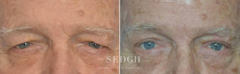 Upper Blepharoplasty Before and After | Sedgh