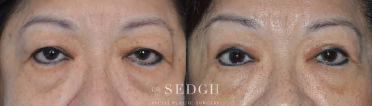 Upper Blepharoplasty Before and After | Sedgh