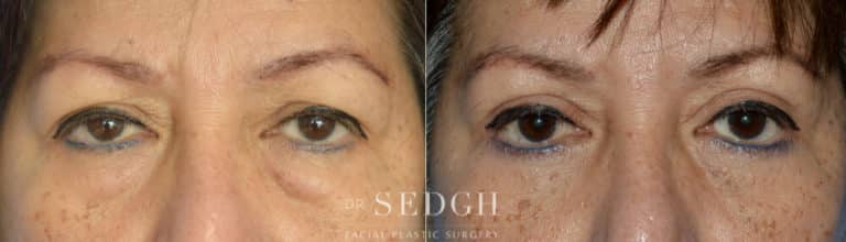 Upper Blepharoplasty Before and After | Sedgh