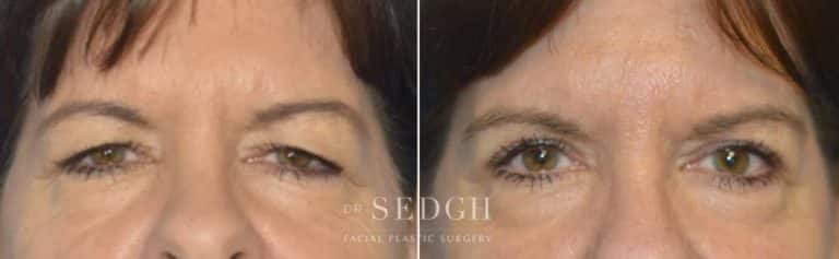 Brow Lift Before and After | Sedgh