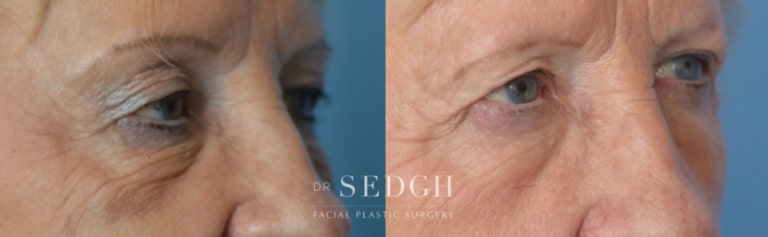 Brow Lift Before and After | Sedgh