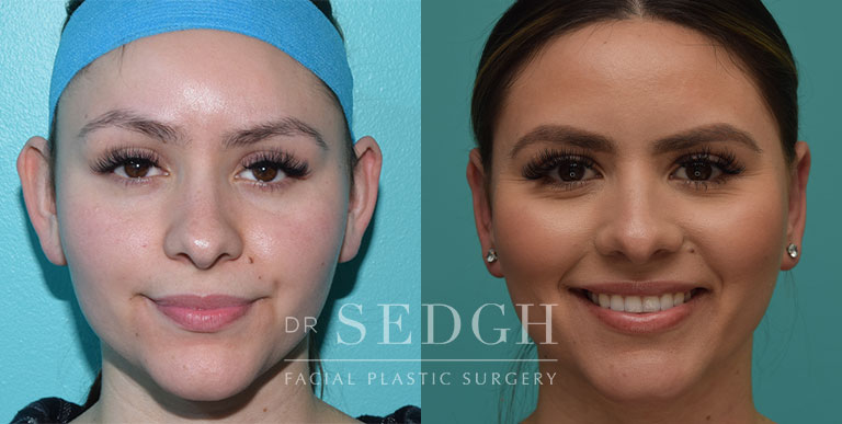 Ear Pinning Surgery Before and After | Sedgh