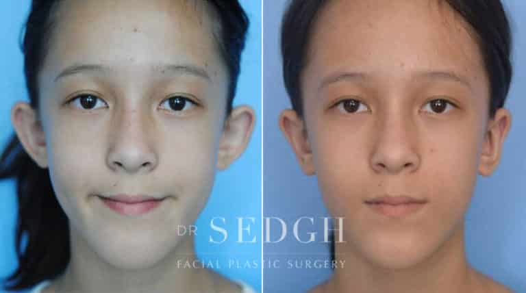 Ear Pinning Surgery Before and After | Sedgh