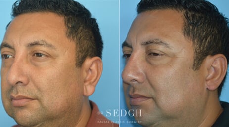 Ear Lobe Reduction Before and After | Sedgh