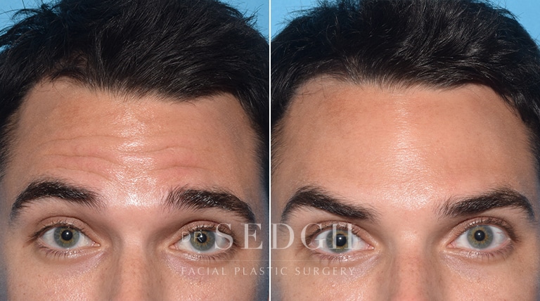 Wrinkle Relaxers Before and After | Sedgh