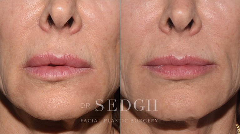 Wrinkle Relaxers Before and After | Sedgh