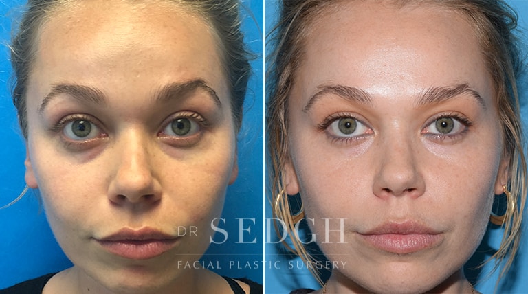 Wrinkle Relaxers Before and After | Sedgh