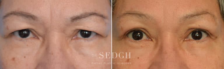 ASIAN EYELID SURGERY