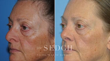 Revision Rhinoplasty Before and After | Sedgh