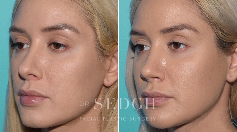 Female Rhinoplasty Before and After | Sedgh