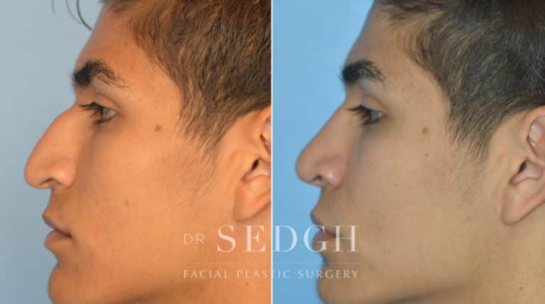 Latino Rhinoplasty Before and After | Sedgh