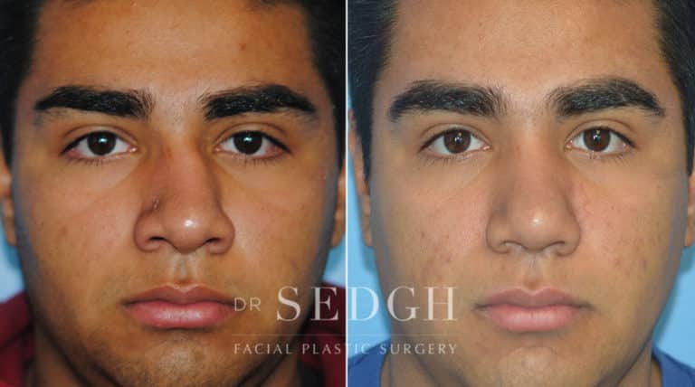 Latino Rhinoplasty Before and After | Sedgh