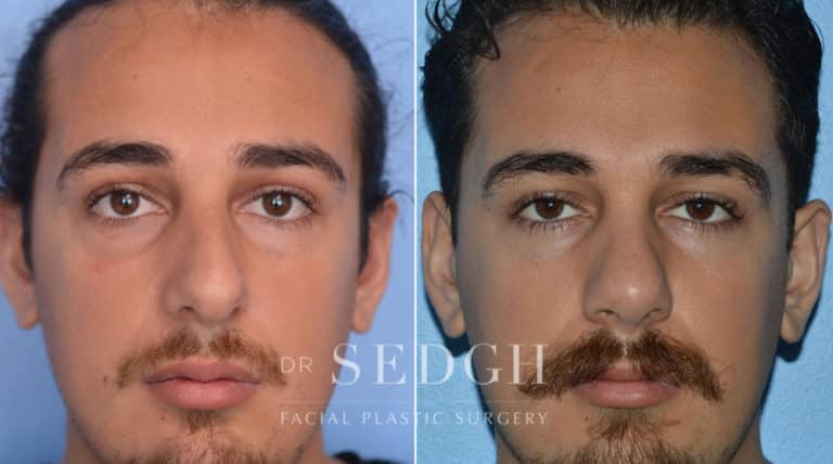 Latino Rhinoplasty Before and After | Sedgh