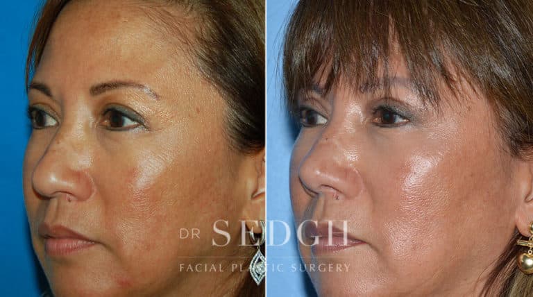 Latino Rhinoplasty Before and After | Sedgh