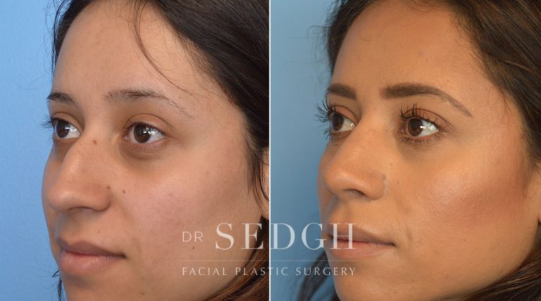 Latino Rhinoplasty Before and After | Sedgh