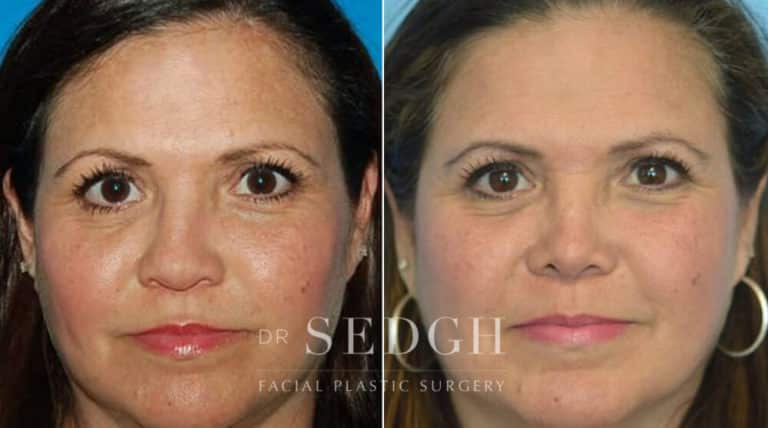 Latino Rhinoplasty Before and After | Sedgh