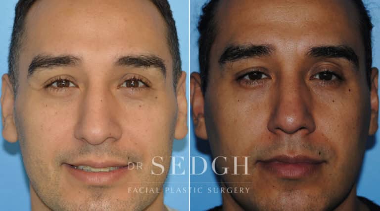 Latino Rhinoplasty Before and After | Sedgh