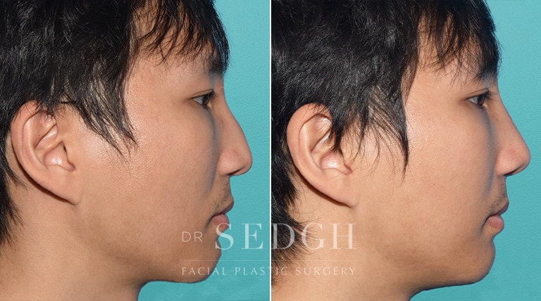 Asian Rhinoplasty Before and After | Sedgh