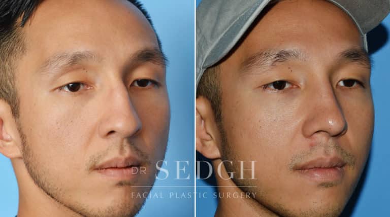 Asian Rhinoplasty Before and After | Sedgh