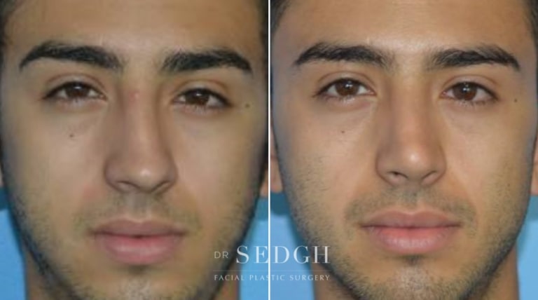 Rhinoplasty Before and After | Sedgh