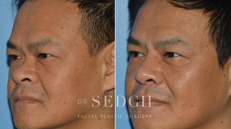 Asian Rhinoplasty Before and After | Sedgh