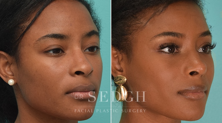 African American Rhinoplasty Before and After | Sedgh