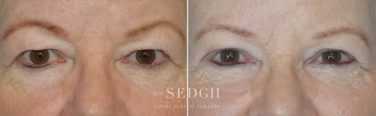 Upper Blepharoplasty Before and After | Sedgh