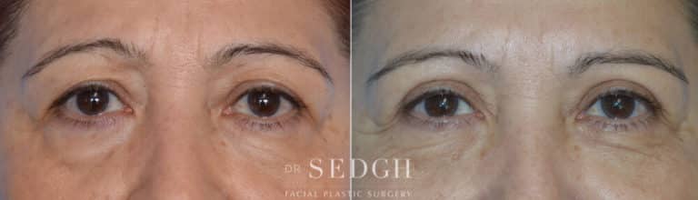 Upper Blepharoplasty Before and After | Sedgh