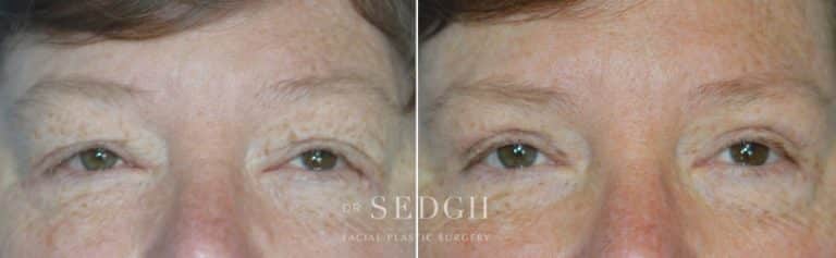 Upper Blepharoplasty Before and After | Sedgh