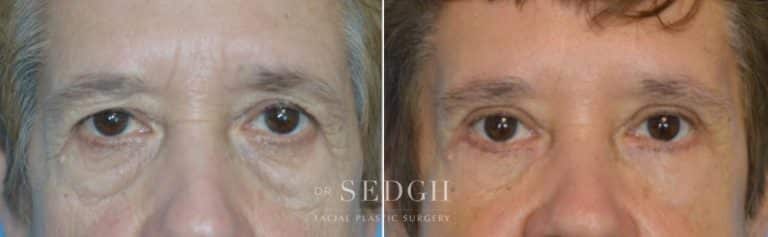 Upper Blepharoplasty Before and After | Sedgh