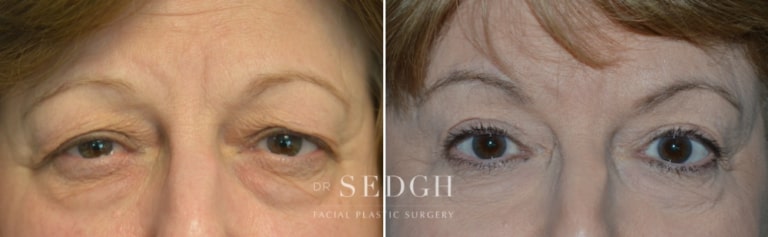 Upper Blepharoplasty Before and After | Sedgh