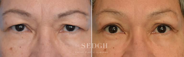 Upper Blepharoplasty Before and After | Sedgh