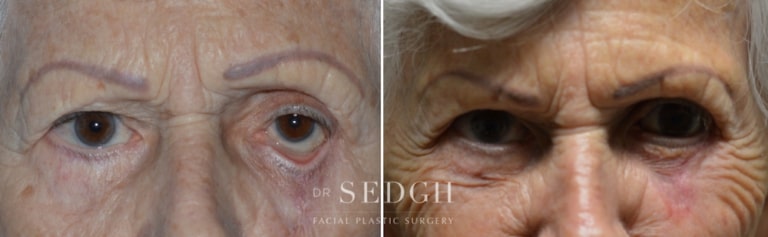 Lower Blepharoplasty Before and After | Sedgh
