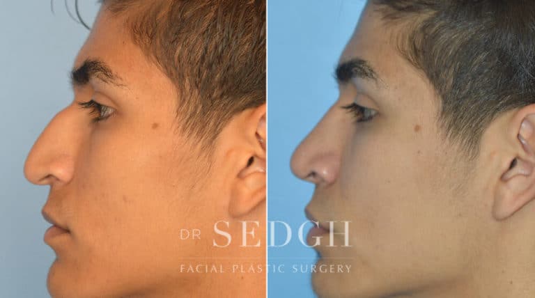 Latino Rhinoplasty