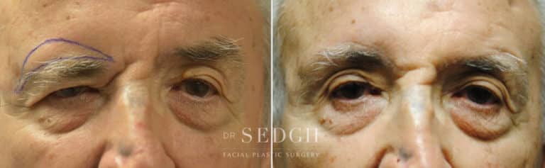 Brow Lift Before and After | Sedgh