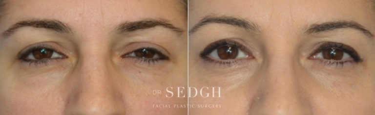 Brow Lift Before and After | Sedgh