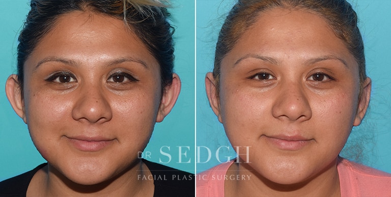 Ear Pinning Surgery Before and After | Sedgh