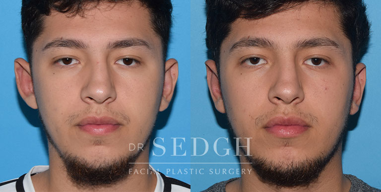 Ear Pinning Surgery Before and After | Sedgh