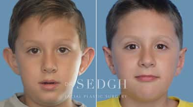 Ear Pinning Surgery Before and After | Sedgh