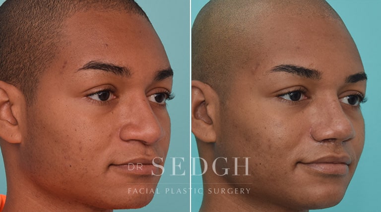 Lip Lift Before and After | Sedgh