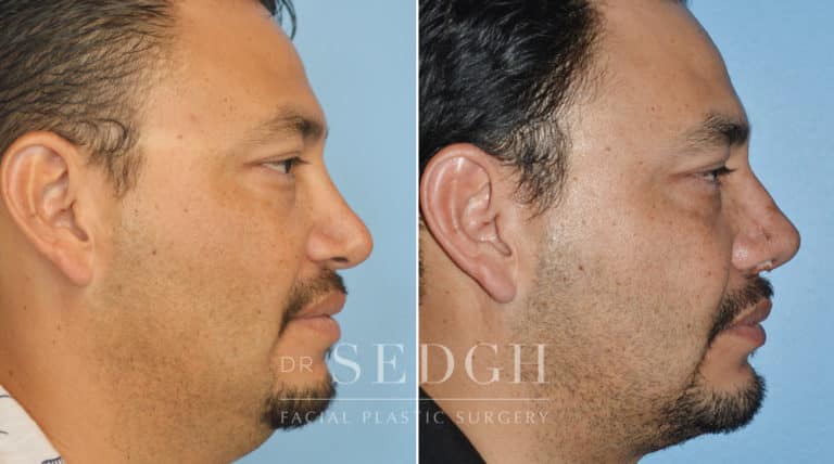 Neck Liposuction Before and After | Sedgh