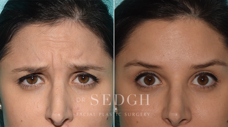 Wrinkle Relaxers Before and After | Sedgh