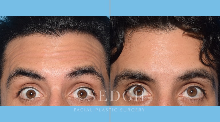 Wrinkle Relaxers Before and After | Sedgh