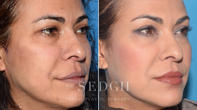 Wrinkle Relaxers Before and After | Sedgh