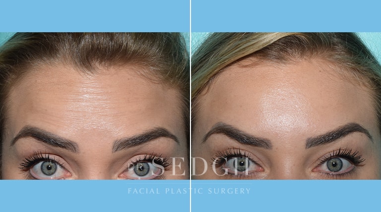 Wrinkle Relaxers Before and After | Sedgh