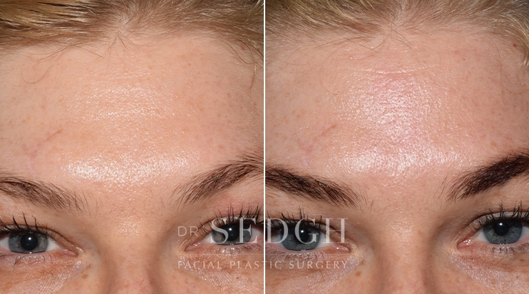 Wrinkle Relaxers Before and After | Sedgh